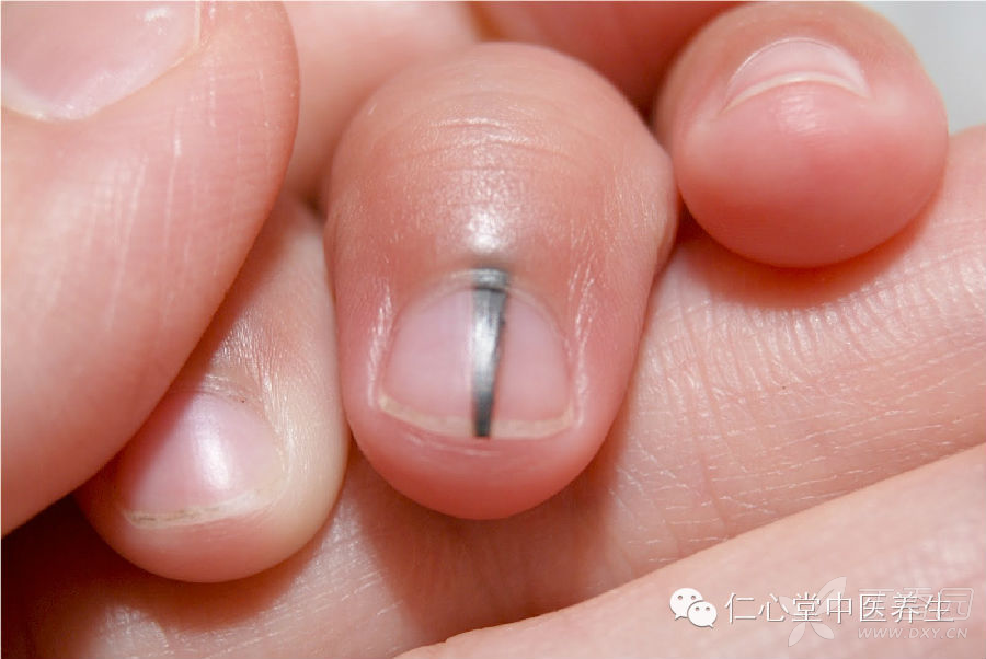 指甲下有发丝粗细的黑线是什么问题?