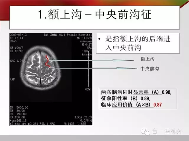 如何在 CT 及 MRI 图像上辨识脑沟回