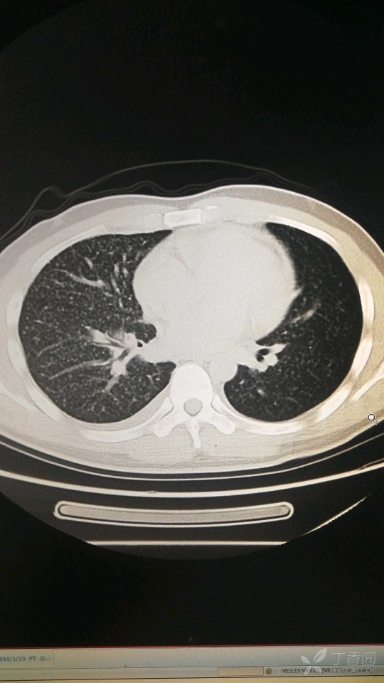 这是个29岁病人的ct 大家看下是不是肺癌