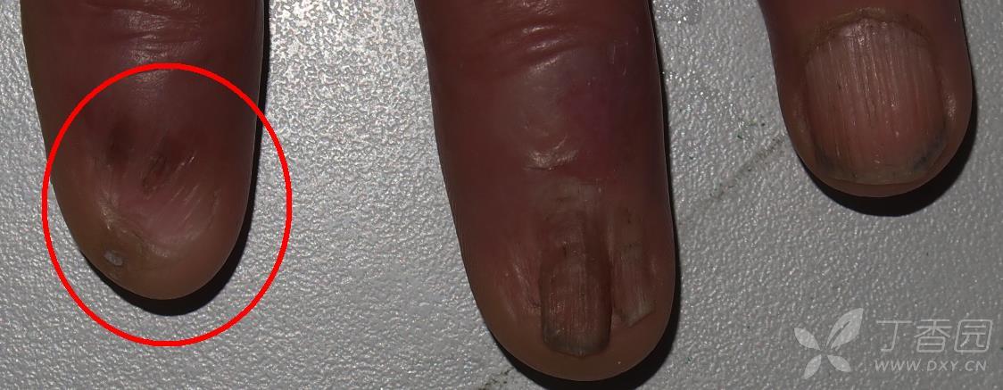 各位战友好,指甲顶针样改变需要做哪些检查 [病例帖]
