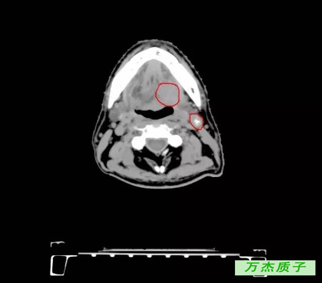 舌根癌质子治疗存活八年 完全治愈 丁香园