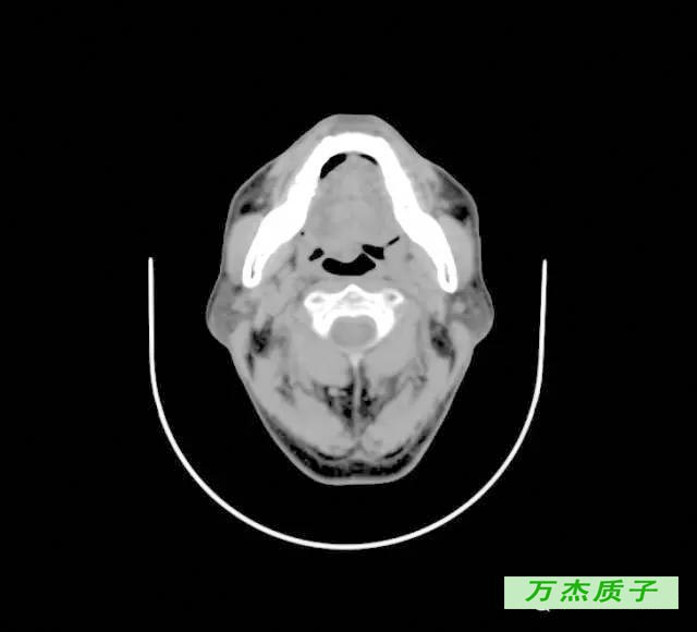 舌根癌质子治疗存活八年 完全治愈 丁香园