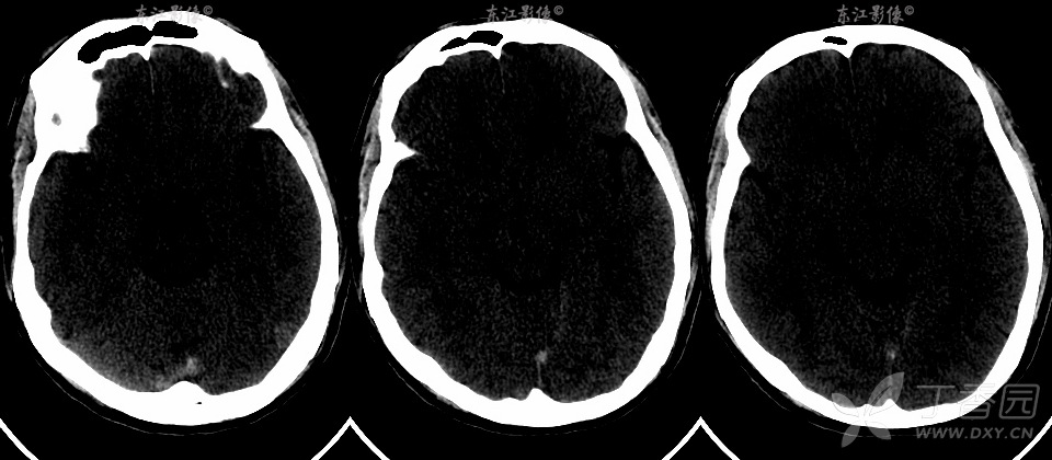 ct 3步轻轻松松诊断急性静脉窦血栓
