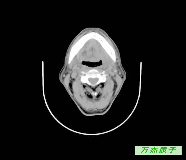 舌根癌质子治疗存活八年 完全治愈 丁香园