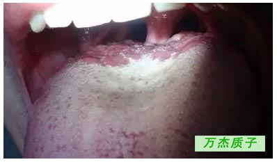 舌根癌质子治疗存活八年 完全治愈 丁香园