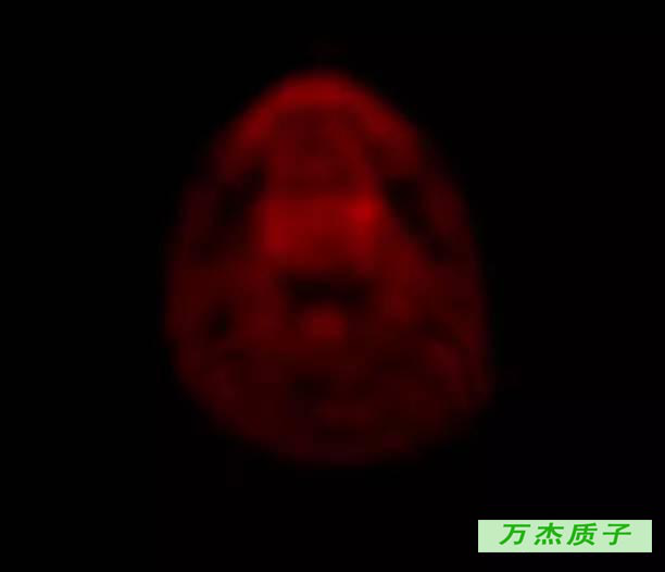 舌根癌质子治疗存活八年 完全治愈 丁香园