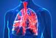 Medscape 精选 |肺栓塞患者的出院后管理