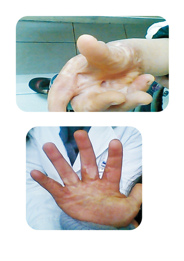 手部烧伤后瘢痕挛缩畸形整形前后对比.jpg