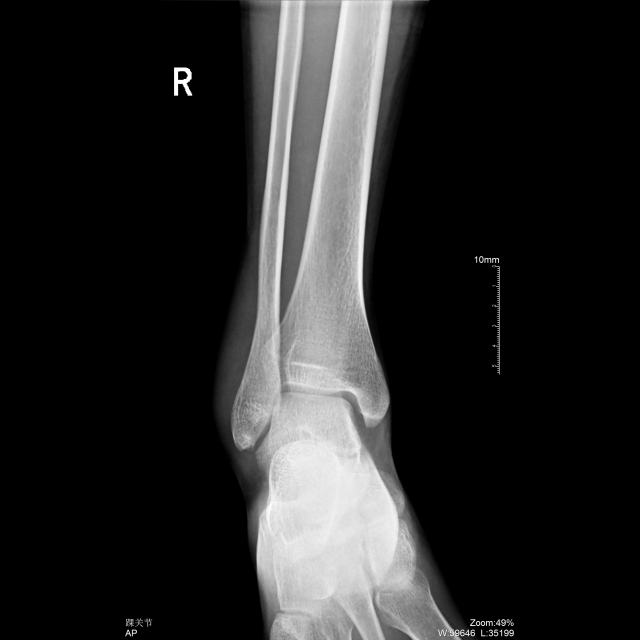 踝关节正常解剖图x线图片