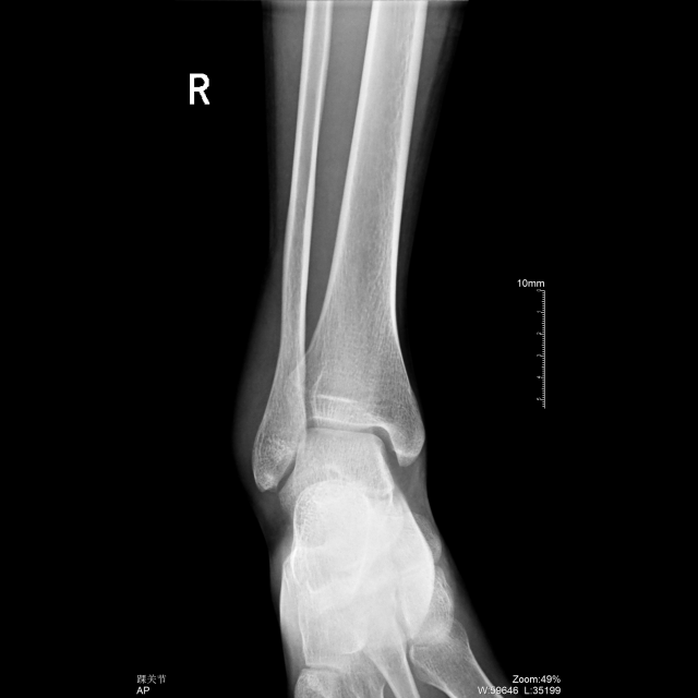 踝关节dr正侧位图片图片