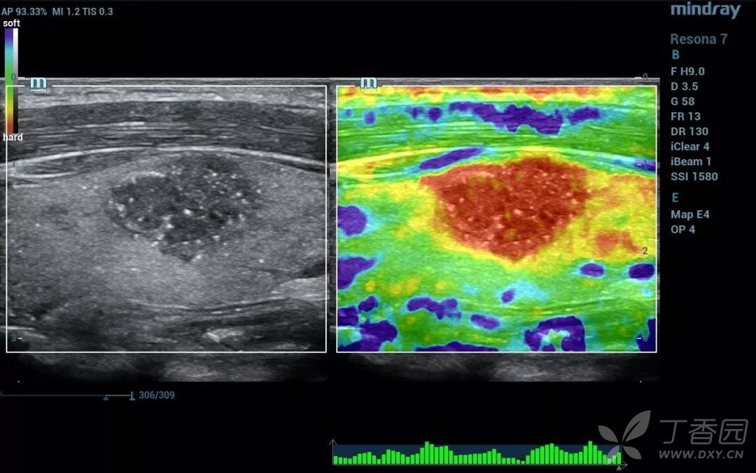 新年第三"弹" | 双模态弹性成像