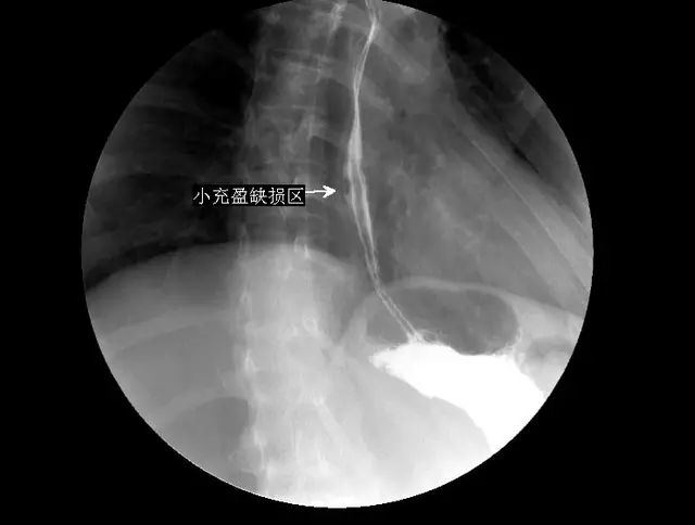 5 分钟读懂消化道造影（食管篇）