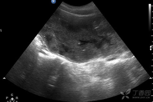 双输尿管不扩张 3324844293956775013-8w.jpg!w640