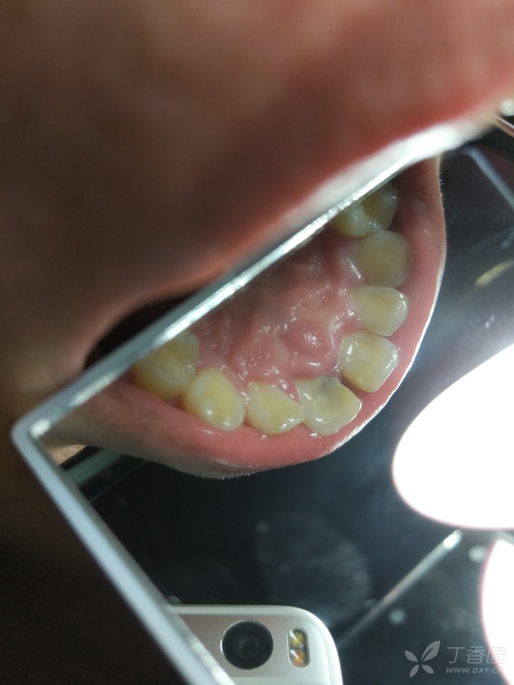 门牙龋齿已补牙,露髓后只能根管治疗了吗? [病例帖]