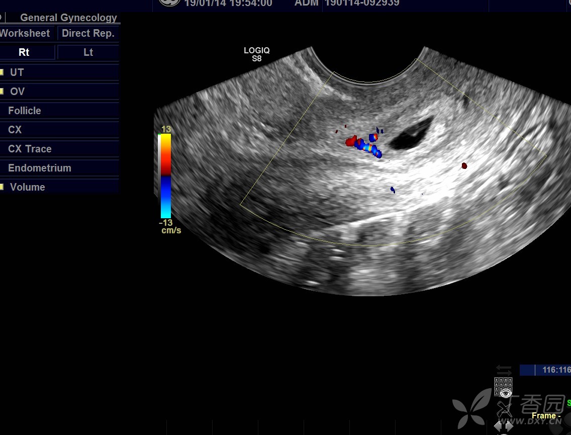 分享一例宫颈管妊娠病例 - 超声医学讨论版 -丁香园论坛