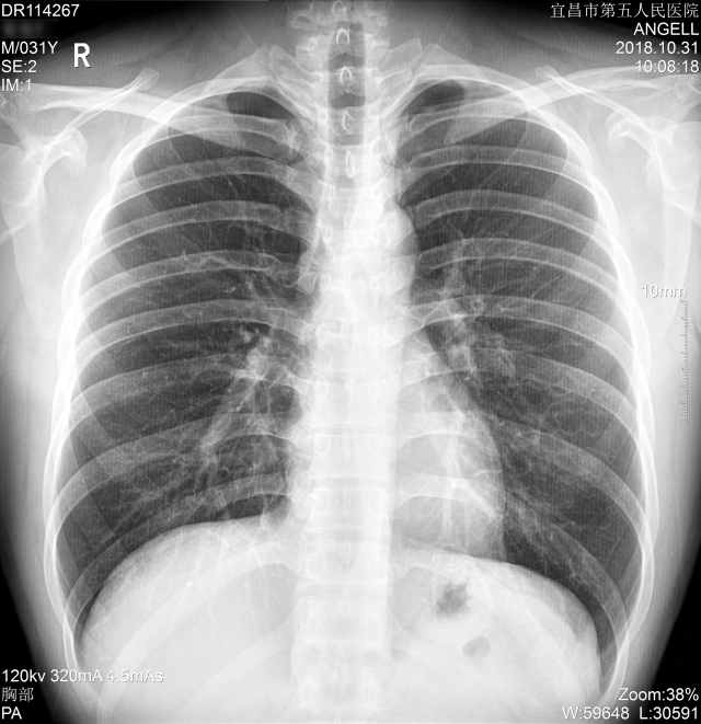 尘肺x线表现图片图片