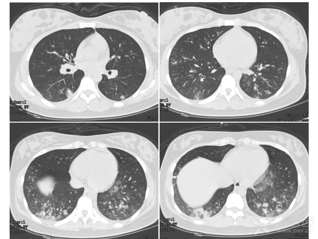 流感季青年男性肺炎,胸部ct