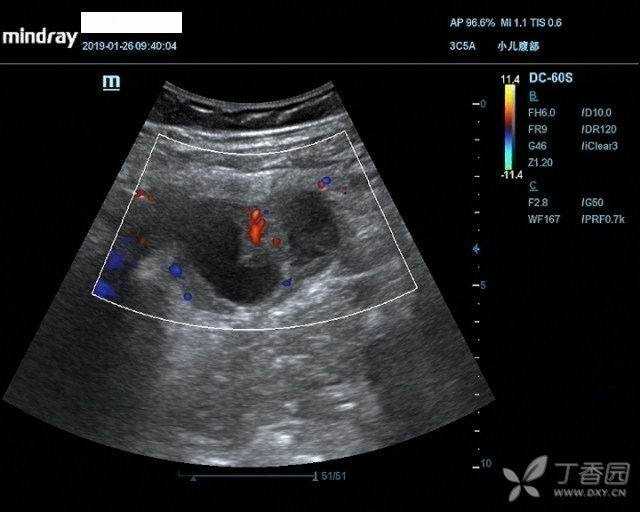 右下回盲部混合性包块,是否阑尾脓肿?