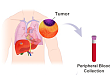 最新研究 | 转移性乳腺癌一线化疗预后监测新突破