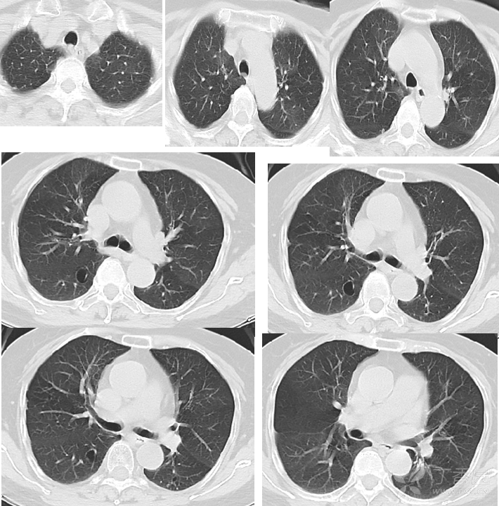 双肺这样的影像改变,支持肺部感染吗? [病例帖]
