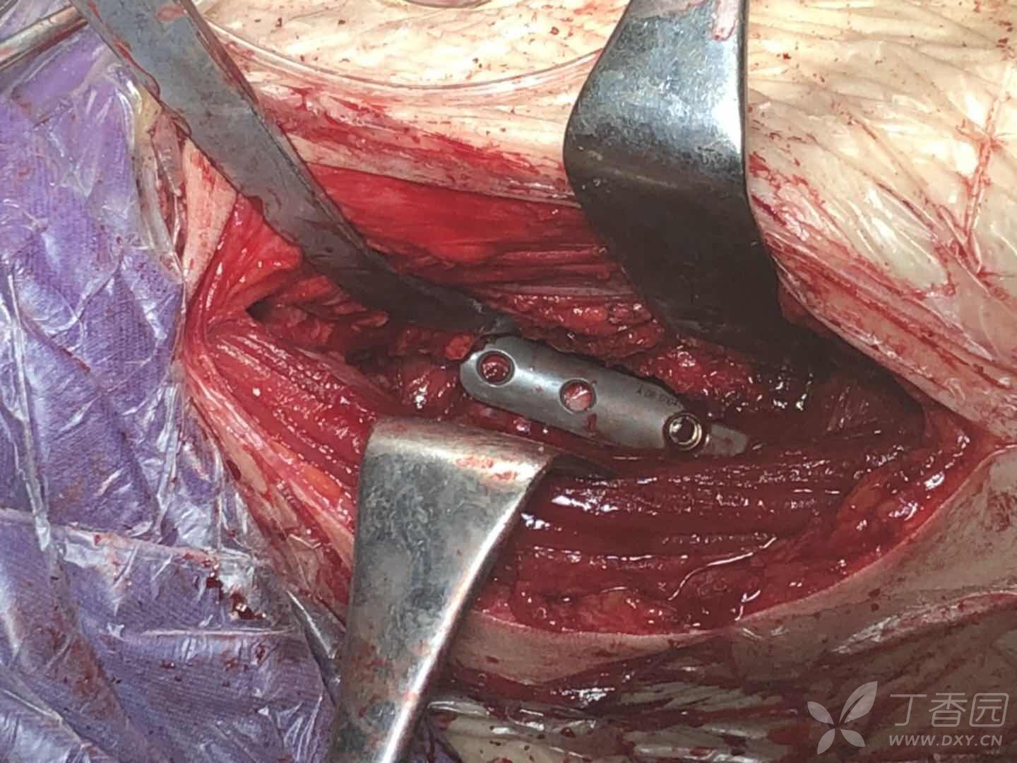 新年第一台手术:股骨颈骨折闭合复内固定 [病例帖]