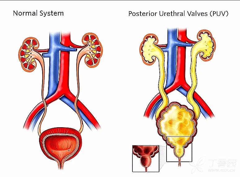 后尿道瓣膜症患儿的肾替代治疗与间歇性导尿风险