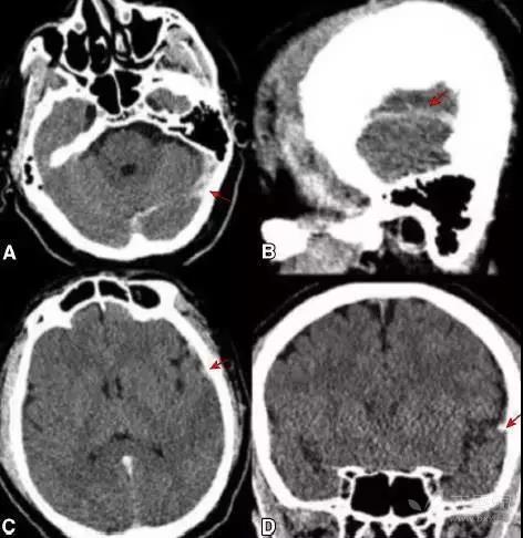 (a,b)平扫 ct 示硬膜静脉窦高密度影;(c,d)采用硬膜下窗,可更好地观察
