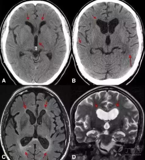 需要明确患者是否存在免疫功能低下,以便帮助诊断