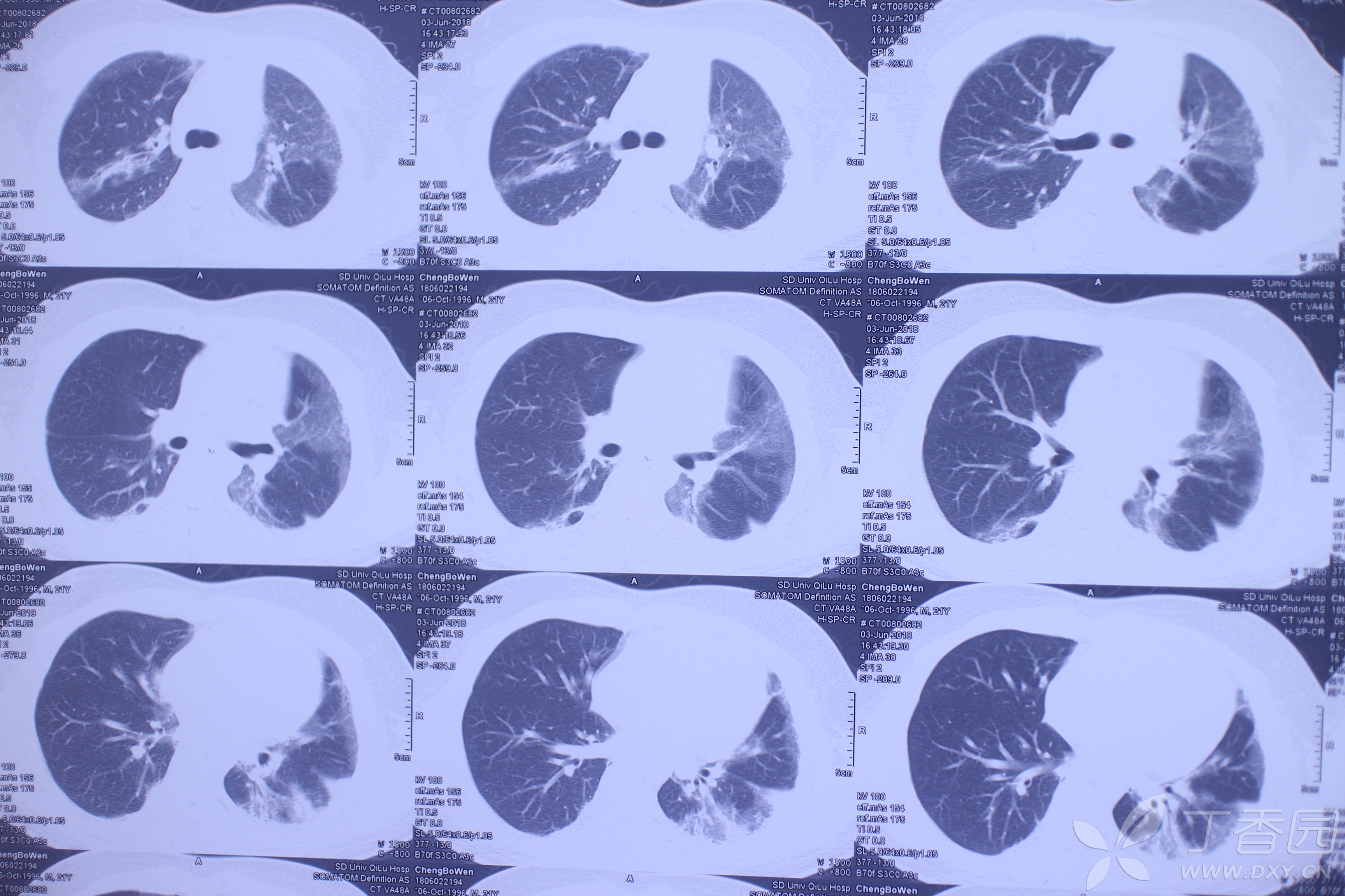 百草枯肺部损伤的特点不会导致进行性肺纤维化病例帖