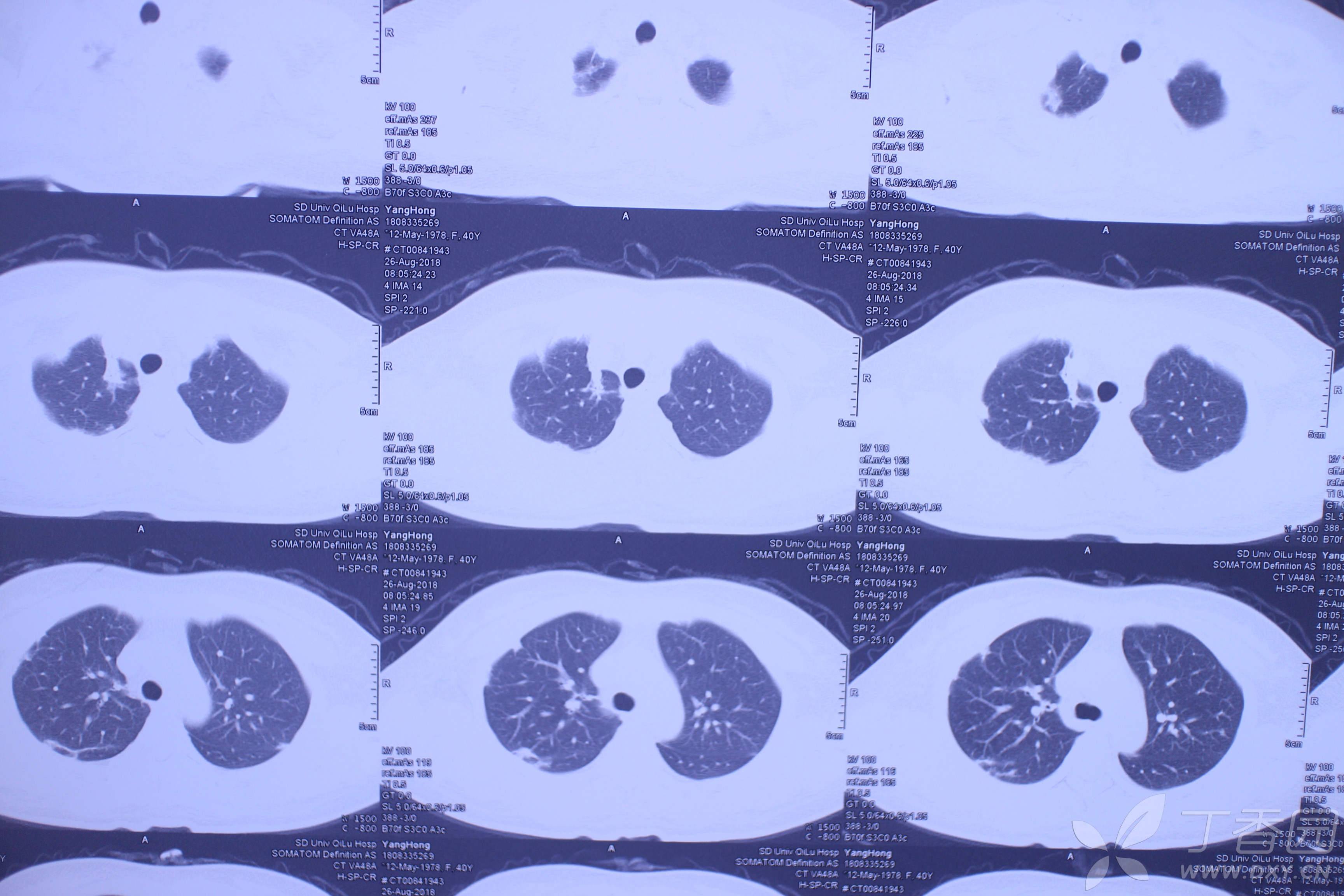 百草枯肺部损伤的特点不会导致进行性肺纤维化病例帖