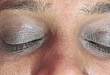 临床图片：这样的黑眼圈要小心