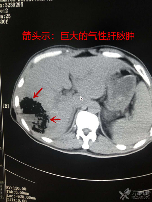 肝脓肿影像图片