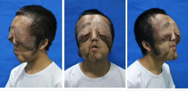 来自甘肃临夏的18岁小杨正值青春年华,却因患有神经纤维瘤症导致面容