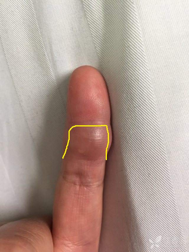 一例手指血管瘤