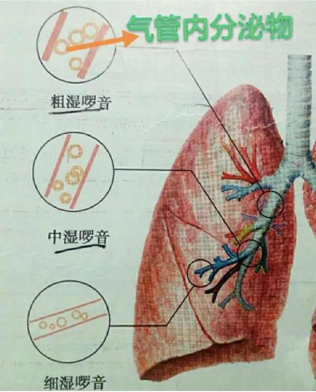 湿啰音 干啰音分不清 3 张图帮你搞定