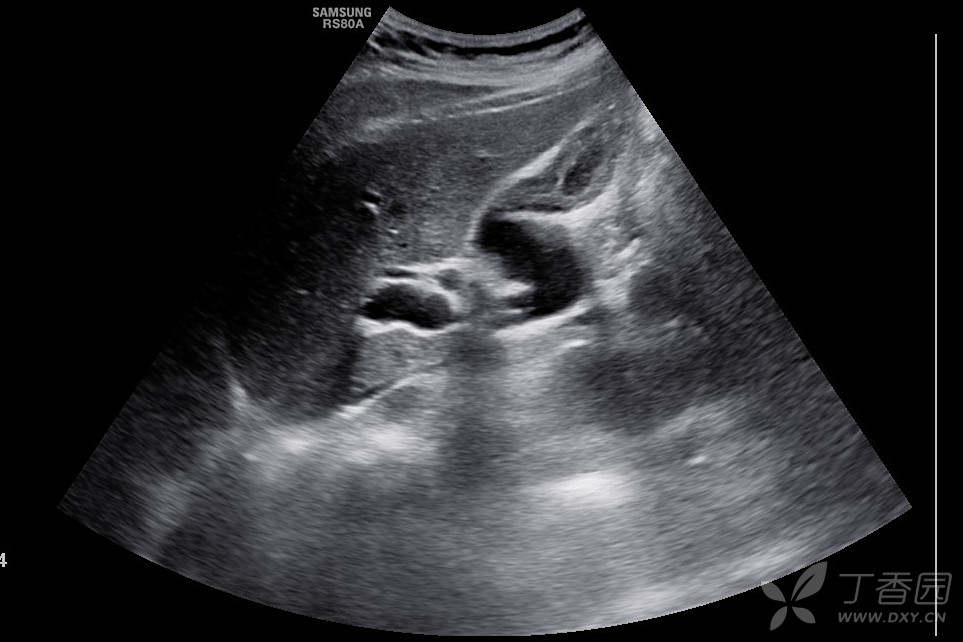 【胆囊】胆囊典型病例传一发 - 超声医学讨论版 - 专业医生社区,医学