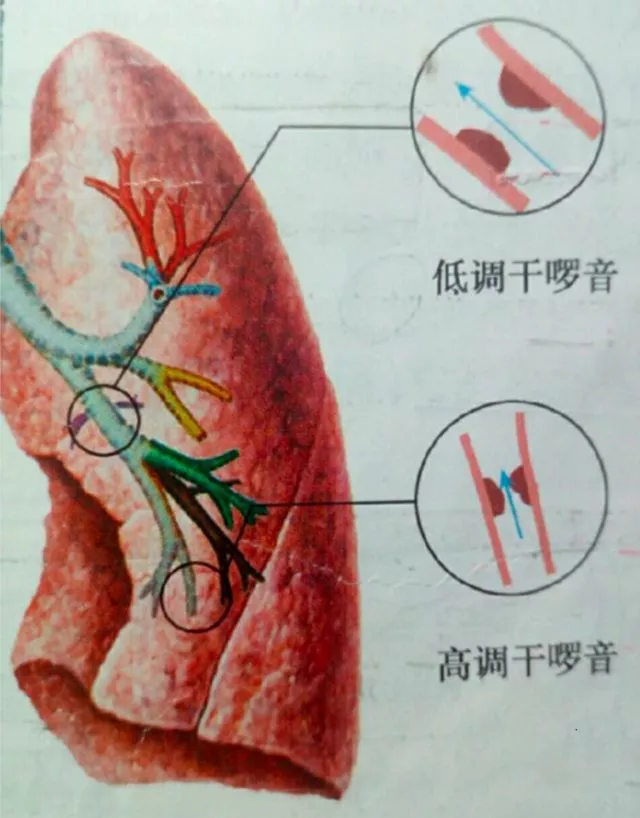 湿啰音 干啰音分不清 3 张图帮你搞定