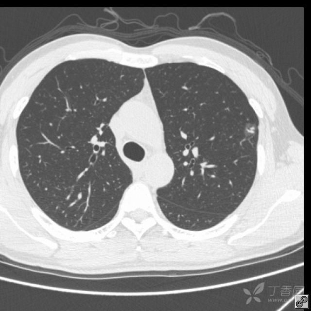 47岁,胸部亚实性结节,请各路高手会诊,下周手术-_病理已出