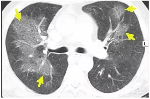 影像入门必备 这6 种胸部ct 征象最常见