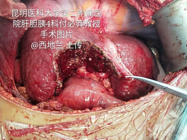 西地兰 肝胆胰外科进修日记 42: 肝巨大肿瘤切除术
