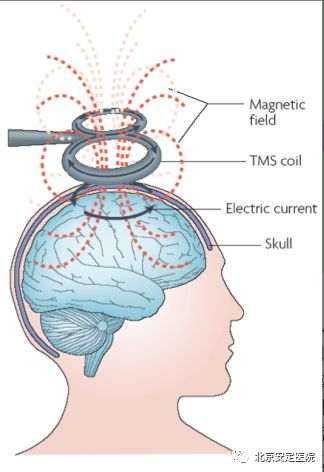 关于经颅磁刺激治疗,你想知道的7个问题都在这里