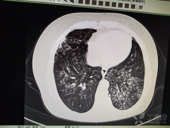 经典图谱,详细解说支气管扩张ct小诀窍:学不会我拜你为师!