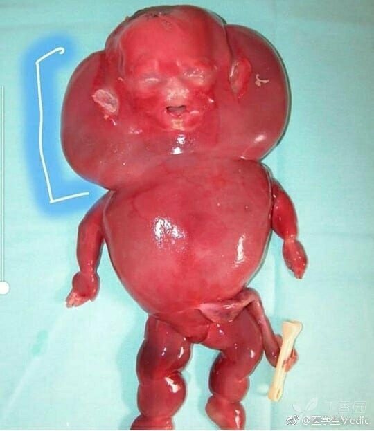六周药流胎儿图片图片