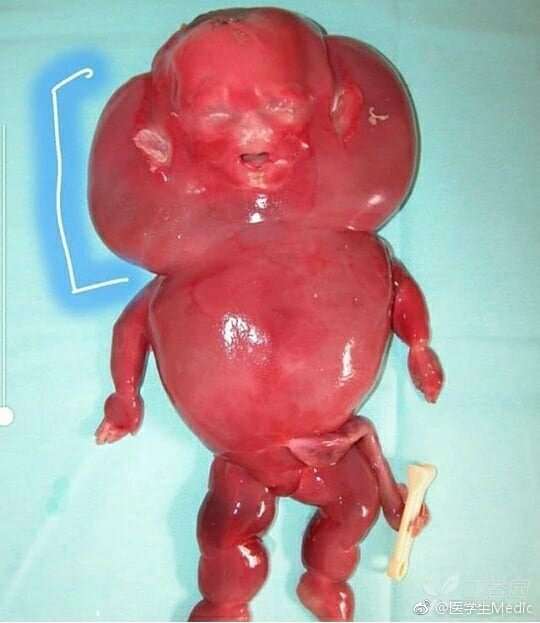 12周引产出来胎儿图片图片