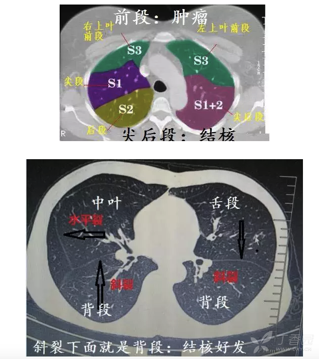 右肺上叶尖后段位置图图片