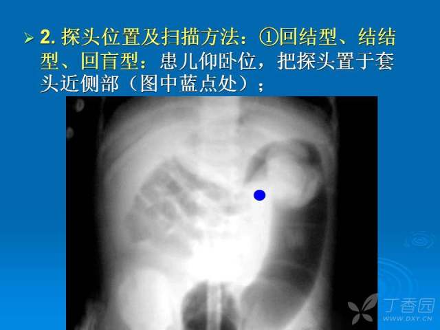 宝宝灌肠的原理是什么_上环是什么原理图片(2)