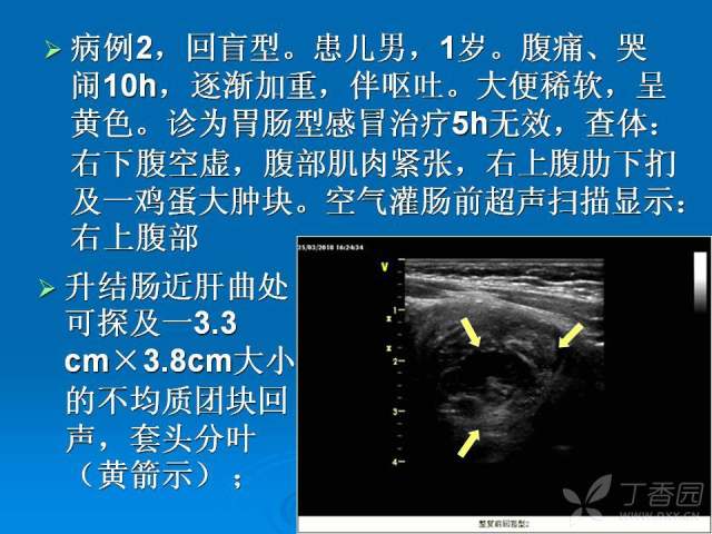 肠套叠超声描述图片