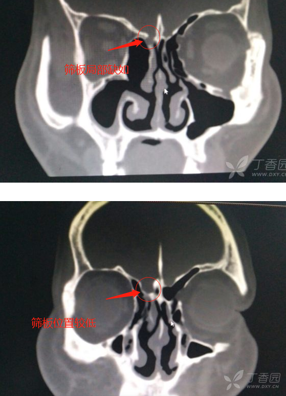 右侧筛板位置较低,局部缺如,估计此处脑脊液渗漏可能.