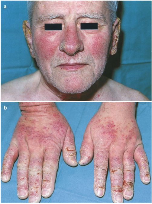 手部水疱 脱屑 还诊断为湿疹 是时候了解这11 种皮肤病了