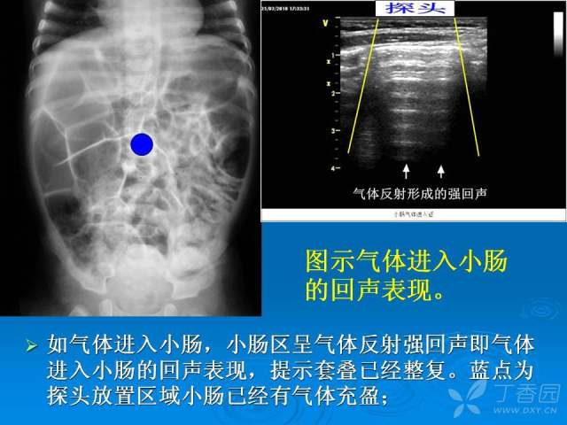 肠套叠超声表现图片